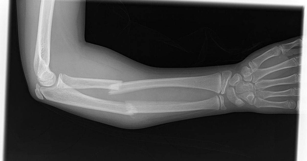 Osso rotto, avambraccio, radiografia
